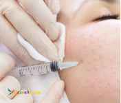 بوتاکس و مزوتراپی با تخفیف