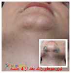 لیزر موهای زائد