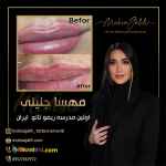 ریموو تاتو خط لب با مواد ارگانیک 