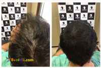 میکرواسکالپ کاشت رنگدانه پزشکی مریم احمدی پور 