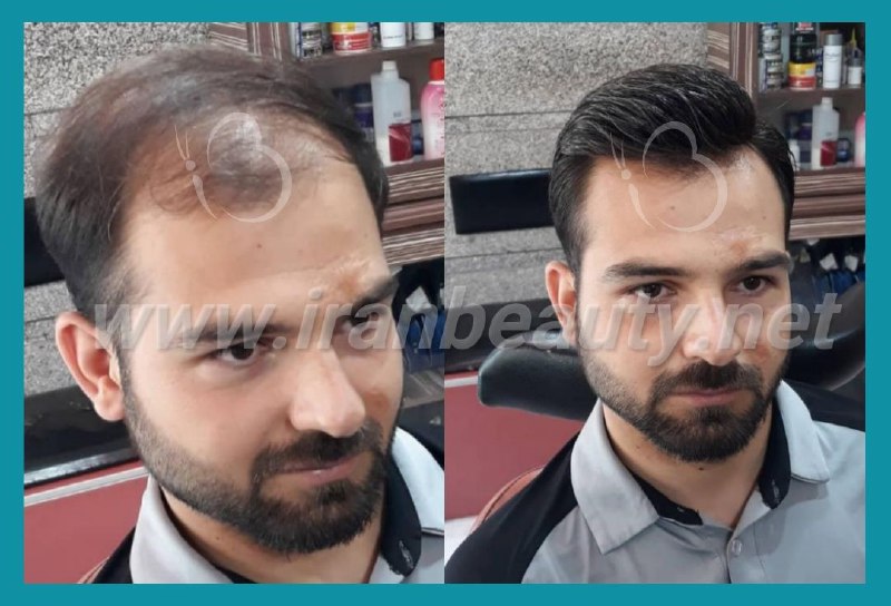 مرکز تخصصی ترمیم مو و زیبایی ایران بیوتی | بهترین کلینیک ترمیم موی سر در تهران | جدیدترین روش های ترمیم مو | ترمیم مو با کلاه گیس با موی طبیعی | ترمیم مو hrt | آدرس ترمیم مو به روش اچ آر تی ترمیم مو | ترمیم مو فیکس آلمان | پروتز مو