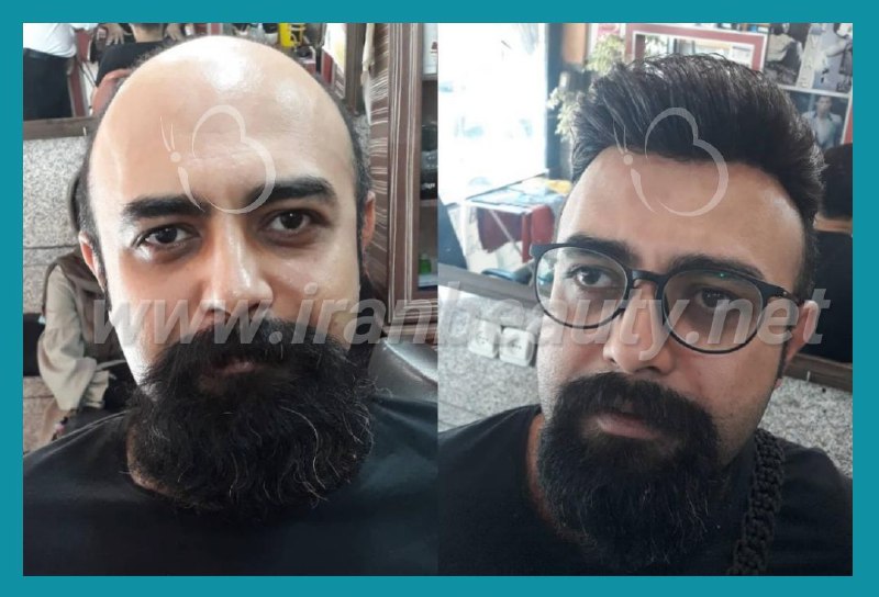 مرکز تخصصی ترمیم مو و زیبایی ایران بیوتی | بهترین کلینیک ترمیم موی سر در تهران | جدیدترین روش های ترمیم مو | ترمیم مو با کلاه گیس با موی طبیعی | ترمیم مو hrt | آدرس ترمیم مو به روش اچ آر تی ترمیم مو | ترمیم مو فیکس آلمان | پروتز مو